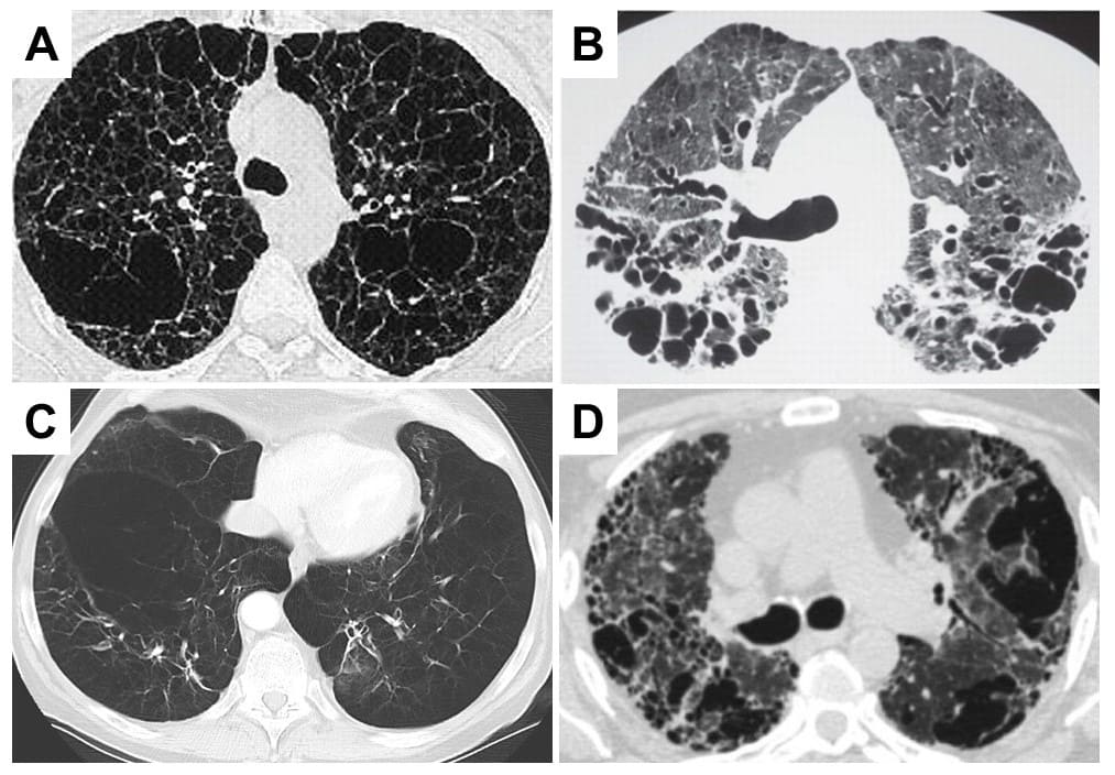 肺機能検査でCOPDを検出できますか?